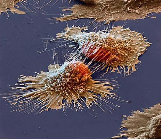Tế bào ung thư dưới kính hiển vi
