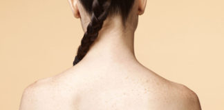 Những nguyên nhân khiến bạn bị mụn ở ngực và lưng không ngờ tới