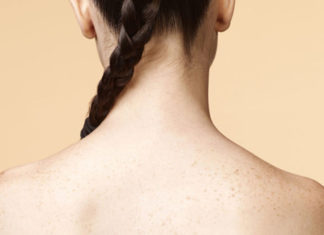 Những nguyên nhân khiến bạn bị mụn ở ngực và lưng không ngờ tới