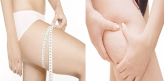 Chăm sóc da: Rạn da và nguyên nhân gây rạn da