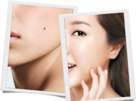 Bí quyết tẩy sạch nốt ruồi không để lại sẹo