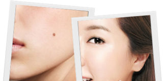 Bí quyết tẩy sạch nốt ruồi không để lại sẹo