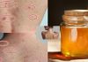Giải pháp cứu cánh cho những cô nàng bị mụn nở hoa trên lưng bằng mật ong siêu đơn giản ngay tại nhà