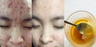 Thổi bay mụn và sẹo thâm trong tích tắc ngay tại nhà bằng “mặt nạ vàng”