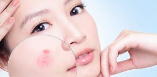 Hướng dẫn làm đẹp: Bí quyết trị mụn “siêu hiệu quả” một phát ăn ngay