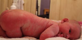 Tìm hiểu cách điều trị viêm da cơ địa cho trẻ sơ sinh hiệu quả