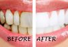 “Chất phát ngất” với công thức tẩy trắng răng nhờ quả chanh