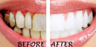 “Chất phát ngất” với công thức tẩy trắng răng nhờ quả chanh