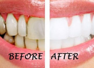 “Chất phát ngất” với công thức tẩy trắng răng nhờ quả chanh