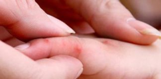 Tất tần tật về bệnh tay chân miệng mà phụ huynh cần lưu ý!