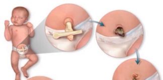 Chăm sóc rốn trẻ sơ sinh đúng cách tại nhà để tránh nhiễm trùng