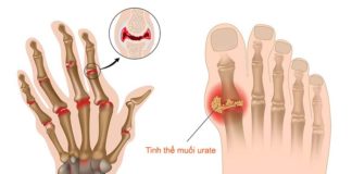 Triệu chứng của bệnh gút và thực đơn điều trị bệnh gút trong 1 tuần