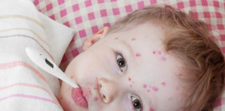 Triệu chứng của bệnh sởi và cách phòng ngừa bệnh sởi mà bạn nên biết