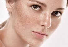 7 mẹo hay xóa tàn nhang cực kì hiệu quả mà bạn nên biết Tàn nhang lan rộng trên bề mặt da gây mất thẩm mỹ nghiêm trọng