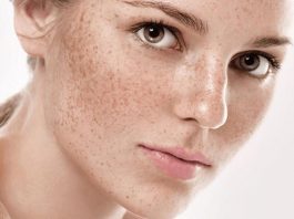 7 mẹo hay xóa tàn nhang cực kì hiệu quả mà bạn nên biết Tàn nhang lan rộng trên bề mặt da gây mất thẩm mỹ nghiêm trọng