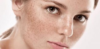 7 mẹo hay xóa tàn nhang cực kì hiệu quả mà bạn nên biết Tàn nhang lan rộng trên bề mặt da gây mất thẩm mỹ nghiêm trọng